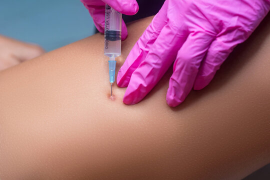 Removal of keloid scars. The beautician gives an injection to renew the skin.