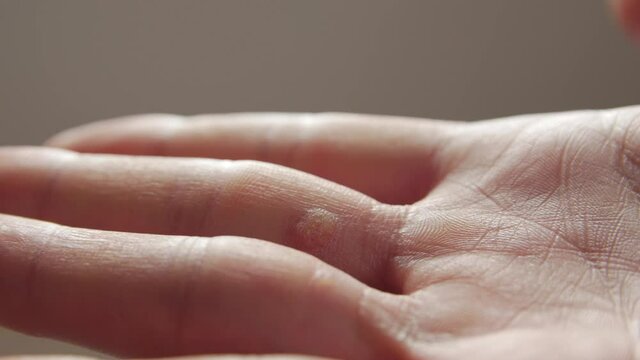 Closeup of a wart man hand macro push in focus transition