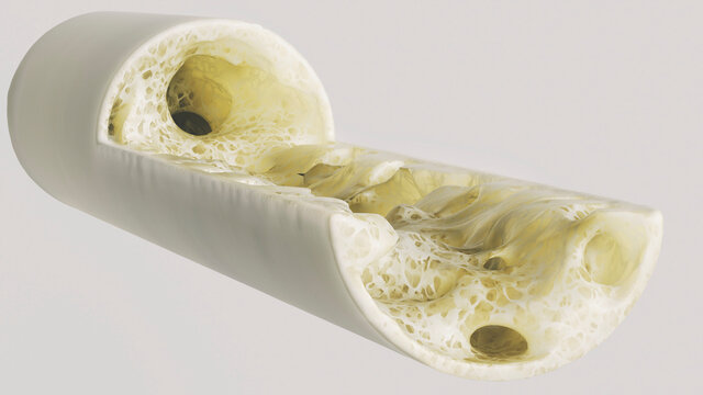 Osteoporosis stage 4 of 4 very detailed -- 3d rendering