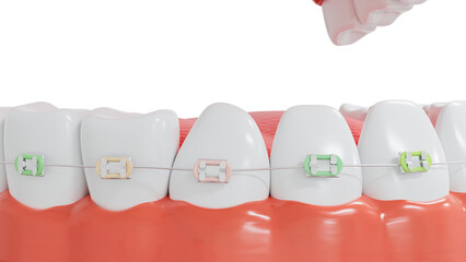 Cosmetic dentistry with Orthodontic bracket on clear white teeth isolated on white background. clipping part. 3d render.