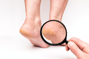 Fototapeta premium Highly dry heels woman on a white background close-up through a magnifying glass