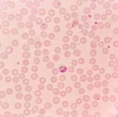 Under 100X light microscope, human parasite on thin film of blood smear with Plasmodium vivax trophozoite form malaria infected red blood cell, selective focus.