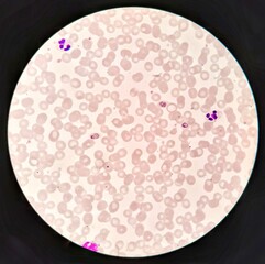 Human parasite form patterns, trophozoite form of Plasmodium ovale malaria infected red blood cells...