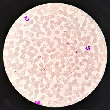 Human parasite form patterns, trophozoite form of Plasmodium ovale malaria infected red blood cells on thin film blood smear under 100X light microscope (Selective focus).