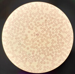 Under 100X light microscope, human parasite on thin film of blood smear with Plasmodium vivax trophozoite form malaria infected red blood cell, selective focus.