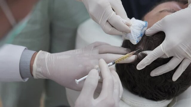 Hair mesotherapy or scalp prp: Platelet-rich plasma procedure. Beautician doctor makes injections in the man head for hair growth to prevent hair loss and baldness