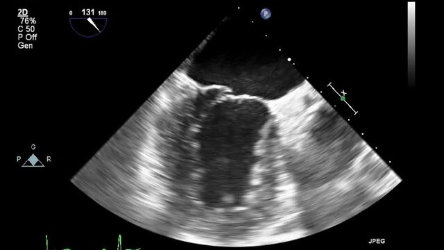 Transesophageal ultrasound video in gray-scale mode.