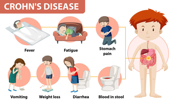 Medical infographic of Crohn's Disease