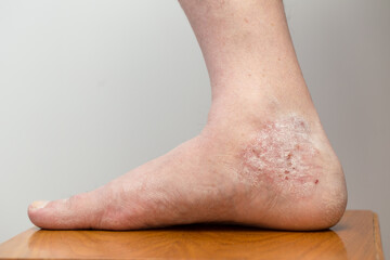 Patient's leg affected by psoriasis