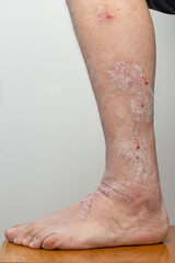 Fototapeta premium Psoriasis: the patient's leg is covered with rashes, wounds, ulcers, scales