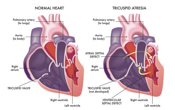 Medical illustration that compare a normal heart with a heart affected by cardiac defect called Tricuspid Atresia, with annotations.