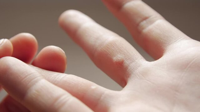Dermatological diseases on fingers hand man skin closeup