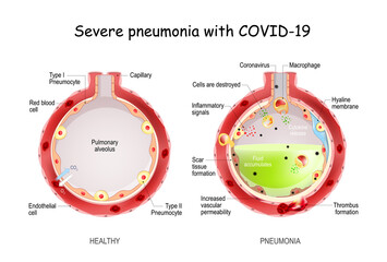 Severe pneumonia with COVID-19.