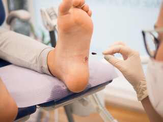Podiatrist treating a verruca on a patient's foot