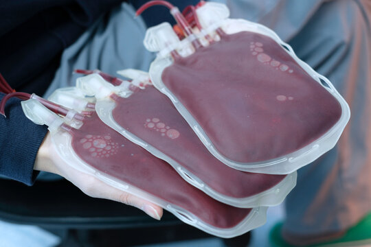 hands holding paked red cells (PRC)  bag for blood transfusion