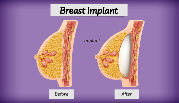 Anatomy of human breast implant