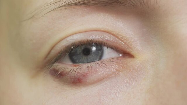 Close-up of a tired red bloody woman eye. conjunctivitis girl red eye.