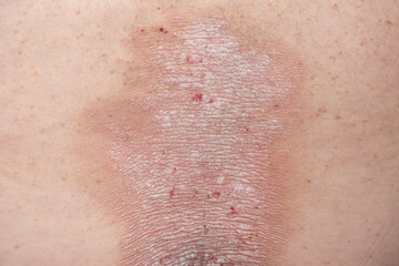 psoriasis: plaques, wounds, rashes, dry skin on the back of a psoriasis patient