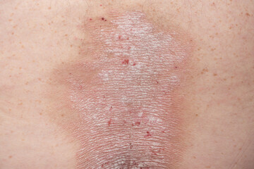 Fototapeta premium psoriasis: plaques, wounds, rashes, dry skin on the back of a psoriasis patient