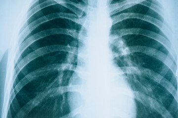 X-ray of the lungs. Fluorogram. Diagnosing lung diseases