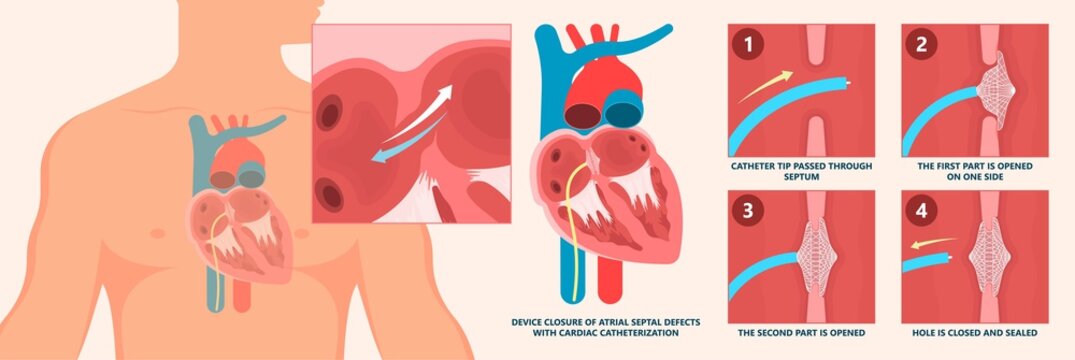 Cath Lab Atrial Septal Defect Tetralogy of Fallot Patent Foramen Ovale Mitral Valve Stenosis Heart Attack Ductus Arteriosus Doppler Coronary Artery Disease Congestive Congenital Valvular VSD exam leak