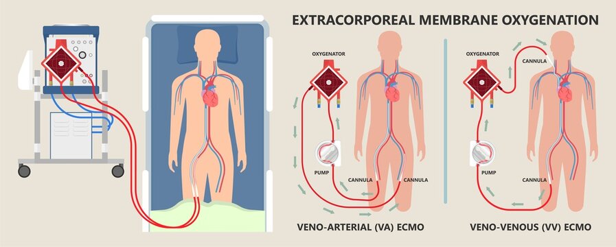 Extracorporeal Membrane Oxygenation ECMO A Life Support System For Respiratory Failure Patient System Illness Damage Infection Perfusionist Ards Transplant Myocarditis Embolism