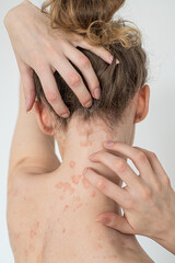 A girl with psoriasis. She can use ointments and creams to cure it and get rid of itching. - obrazy, fototapety, plakaty
