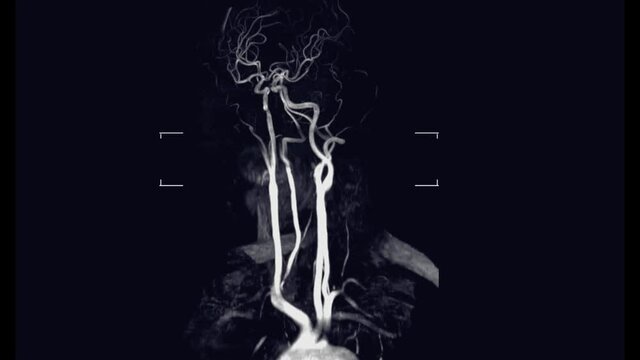 MRA Brain and corotid artery technique Time-of-Flight (TOF)  or Magnetic resonance angiography of head and neck.