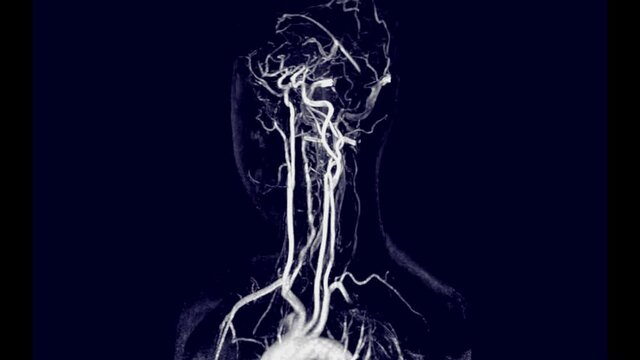 MRA Brain  technique Time-of-Flight (TOF)  or Magnetic resonance angiography after injection gadolinium contrast media agent.