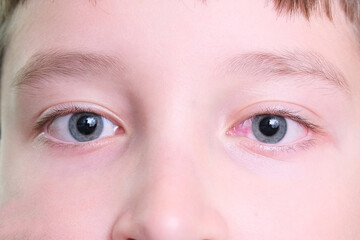 Obraz premium A boy with red irritated eye after long time using gadgets, tired eyes concept
