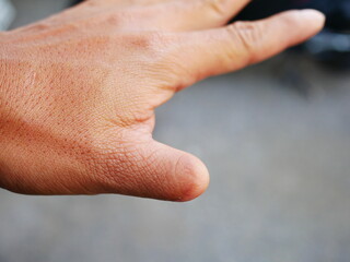 closeup of hand with amputated finger.