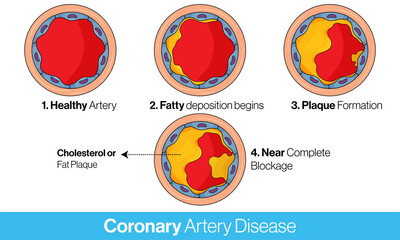 Obraz premium Stages of Coronary artery disease and cholesterol plaque formation vector design