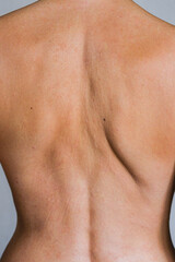 Fototapeta premium Psoriasis skin disease is a dermatic problem, red allergic skin rash.