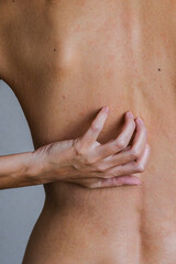 Psoriasis skin disease is a dermatic problem, red allergic skin rash.