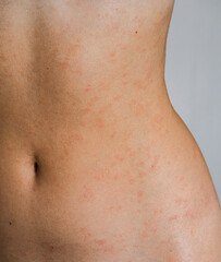 Psoriasis skin disease is a dermatic problem, red allergic skin rash.