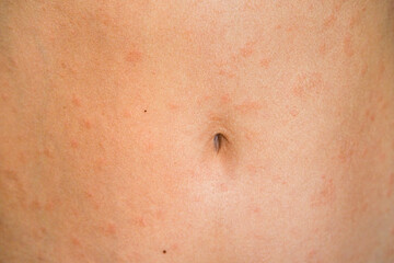 Fototapeta premium Psoriasis skin disease is a dermatic problem, red allergic skin rash.