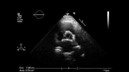 Image of the heart in gray-scale mode during transesophageal ultrasound.