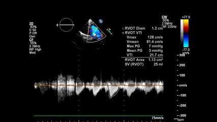 Image of the heart during transesophageal ultrasound with Doppler mode.