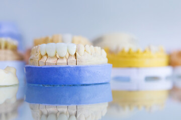 The layout of the jaw of a person with dental implants. Manufacturing and prosthetics of teeth. Dental laboratory.