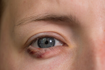 Fototapeta na wymiar close up Blepharitis or Eyelid inflammation eyes