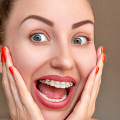 Closeup Braces on Teeth. Woman Smile with Orthodontic Braces Damon