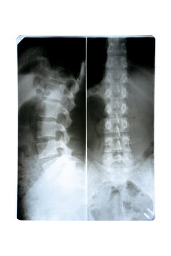 X-ray of the back, lumbar spine. 2 views.