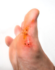 Wounds from removal of warts. Black scars. Contagious skin illness on foot. Medical treatment photo.