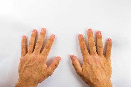 Hands with bitten nails on a white background