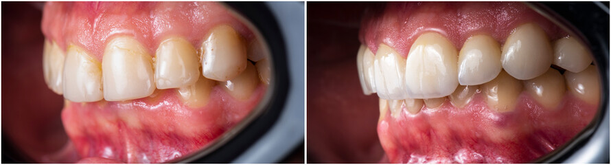 press ceramic crowns and veneers A2 color