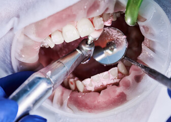 Close up view on cleaning teeth of patient with cheek retractor in mouth and brackets on teeth with...