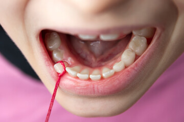 Tearing out a baby's tooth from a girl with a red string. Close-up, selective focus