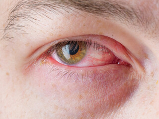 Red eye of an infected person. Conjunctivitis.