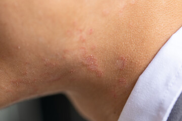 Fototapeta premium Tinea circinata or ringworm on the head. 