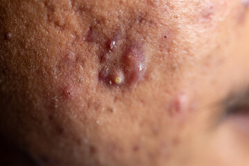 Fototapeta premium Backgrounds of lesions skin caused by acne on the face in the clinic. 